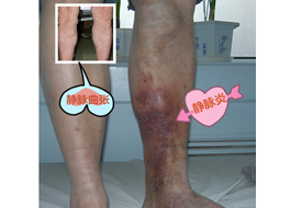 Disease of venous system-Shenzhen Xingyin Pharmaceutical Co., LTD