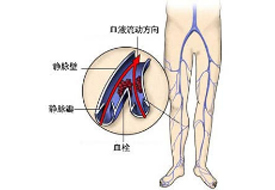 Disease of venous system-Shenzhen Xingyin Pharmaceutical Co., LTD